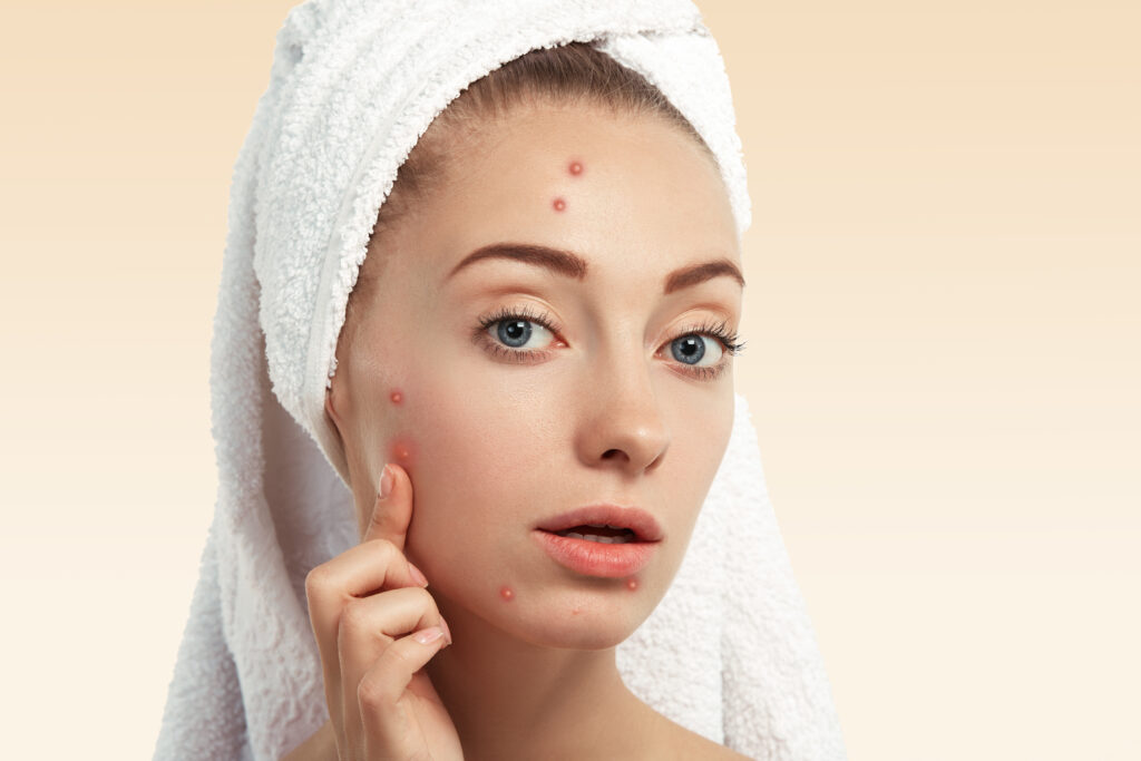 Effective Acne Skin Care Routine at Home